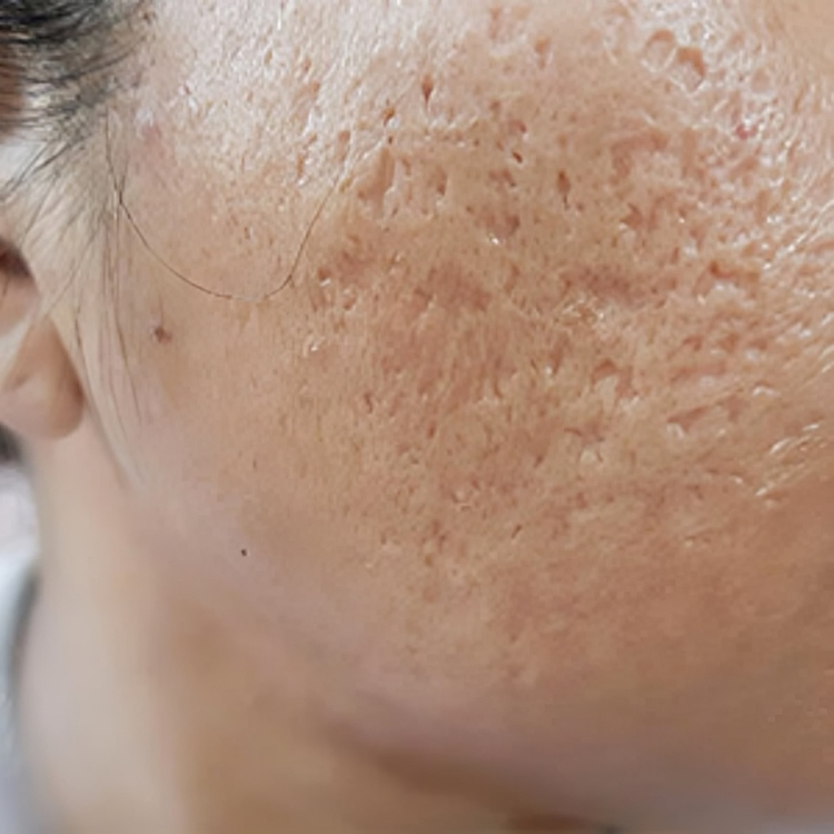 large-pores-scars-treatment